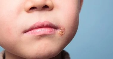 أعراض الهربس الفموي عند الأطفال.. كيفية التعرف عليها وأوقات استشارة الطبيب 9 - Egypodcast. IMG 20260115 WA0008 - Egypodcast.